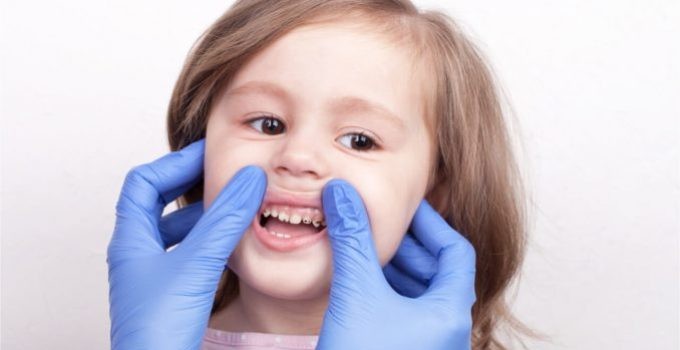 Хүүхдийн шүд, амны хөндийн өвчин түүний урьдчилан сэргийлэлт
